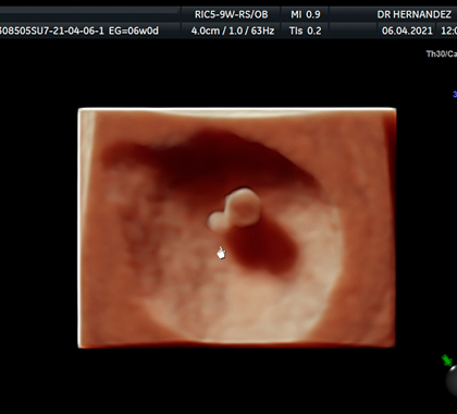 transvaginal ultrasonido embarazo