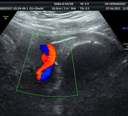 Ultrasonido Doppler embarazo